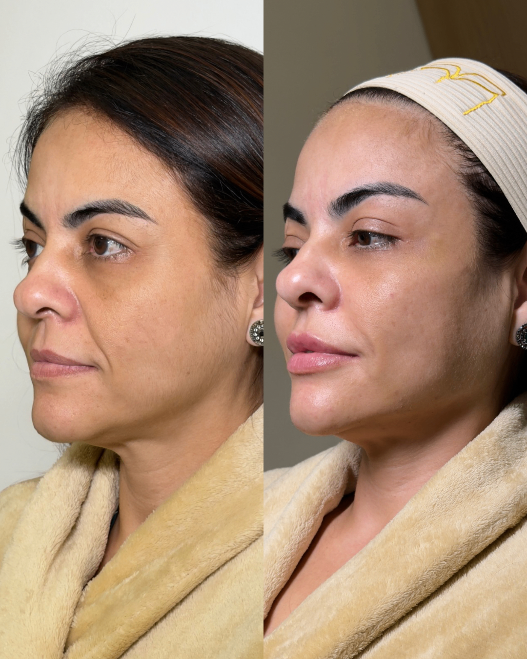 Harmonização Full Face — caso 5