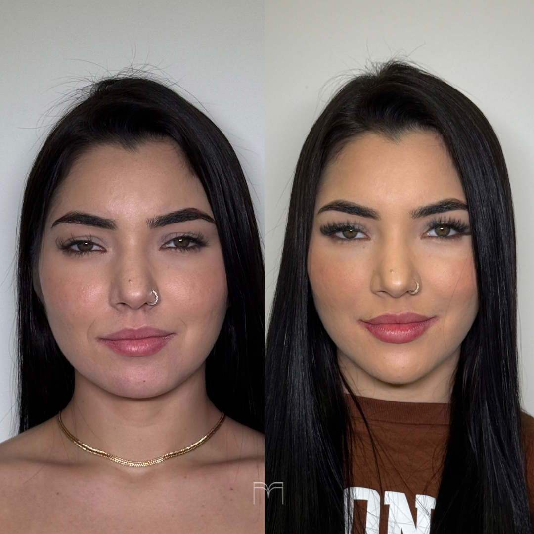 Harmonização Full Face — caso 2