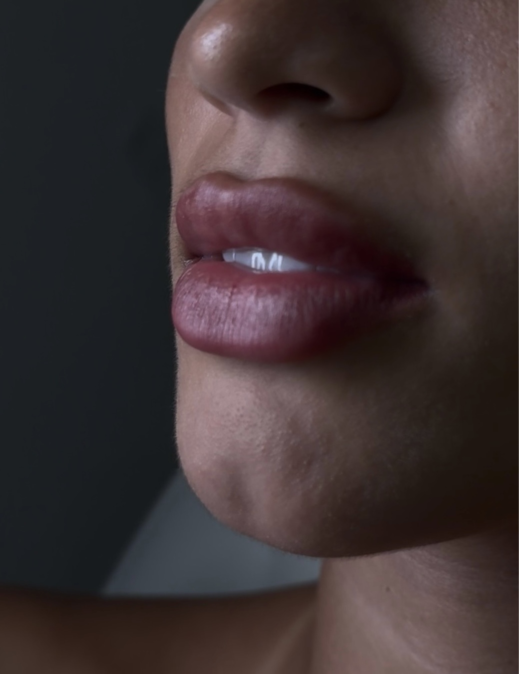 Preenchimento Labial — caso 12