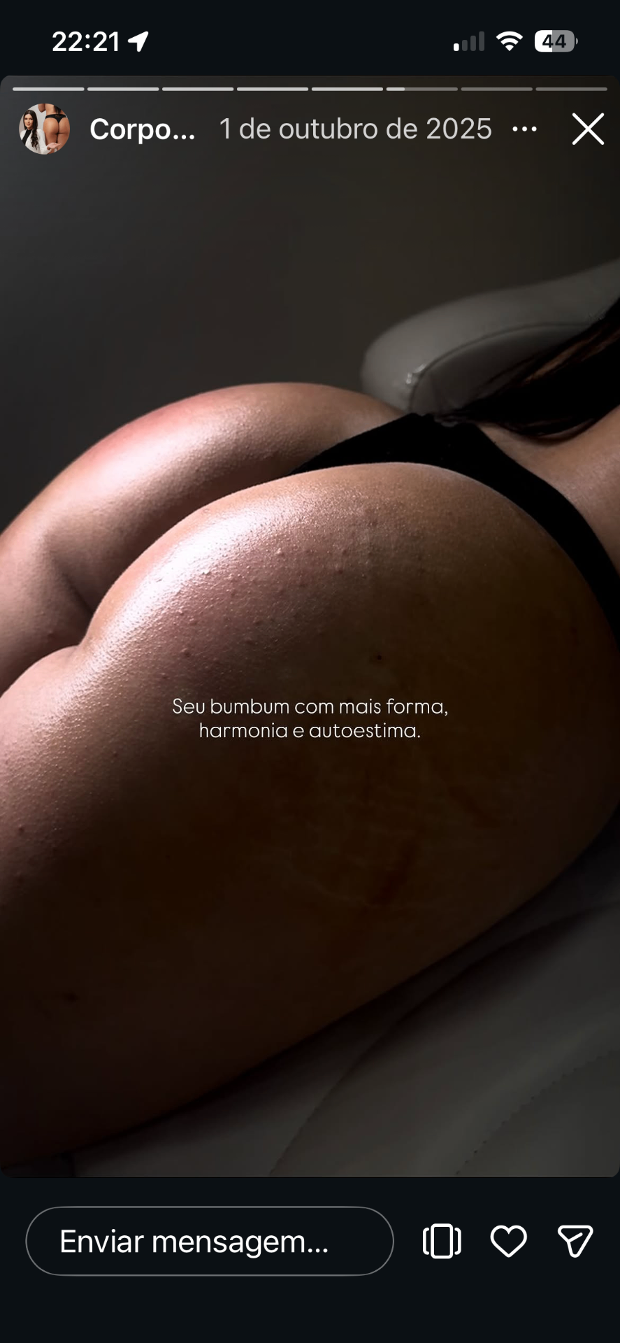 Harmonização Corporal — caso 10