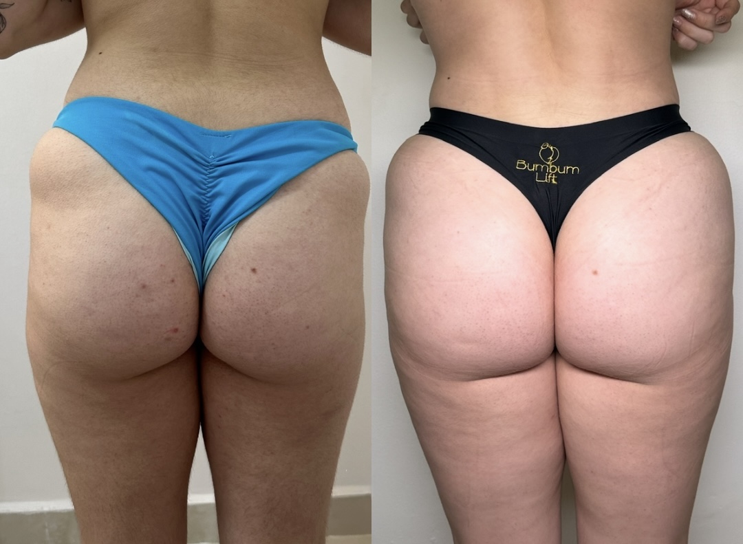 Bumbum Lift — caso 13