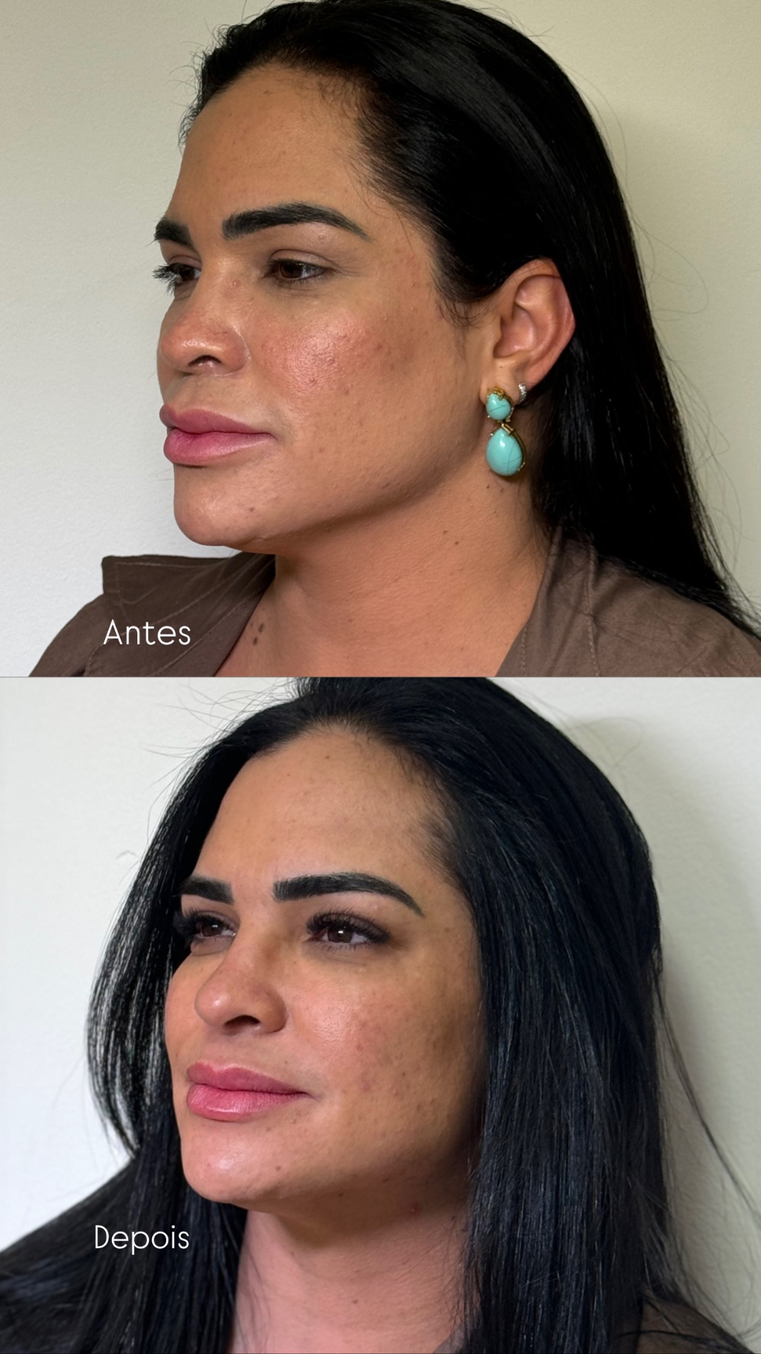 Harmonização Full Face — caso 3