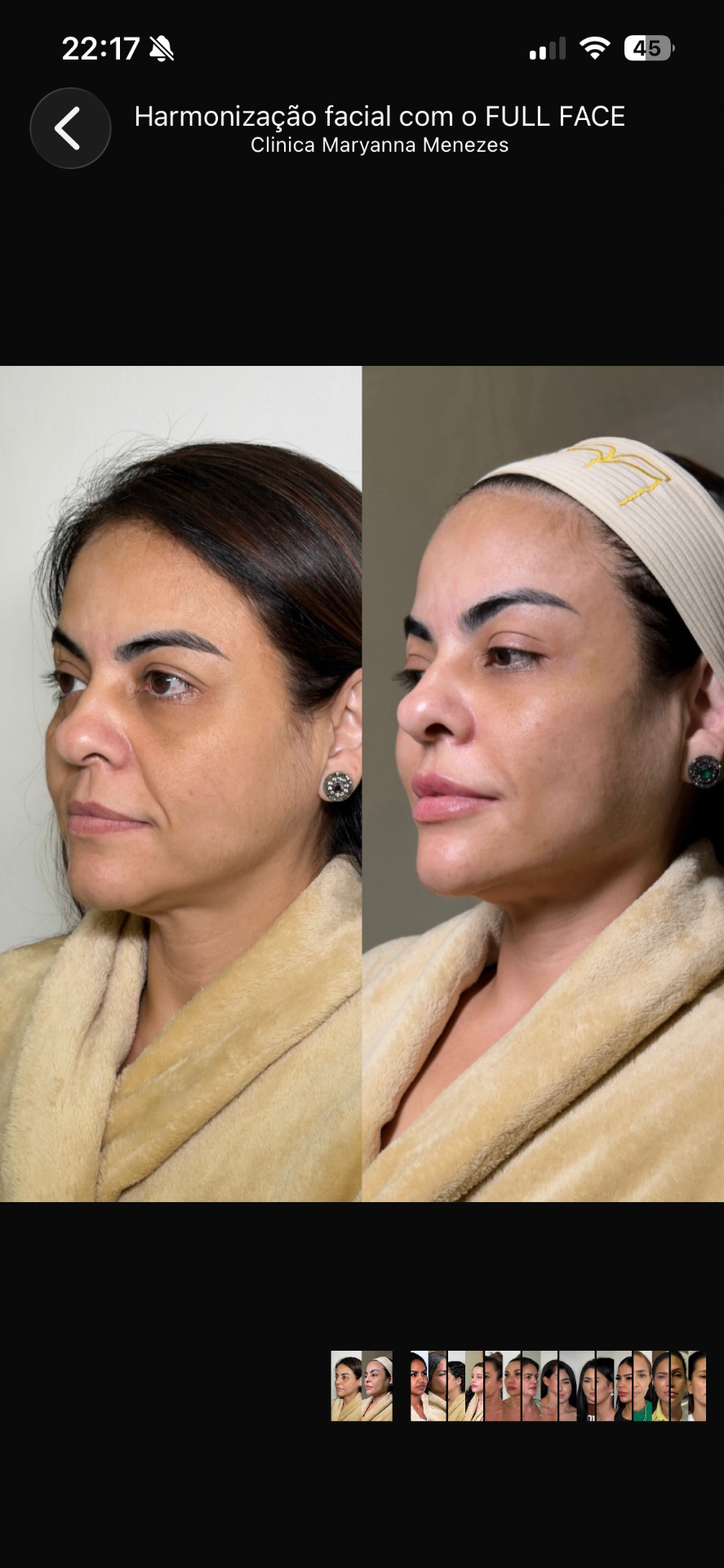 Full Face — caso 2