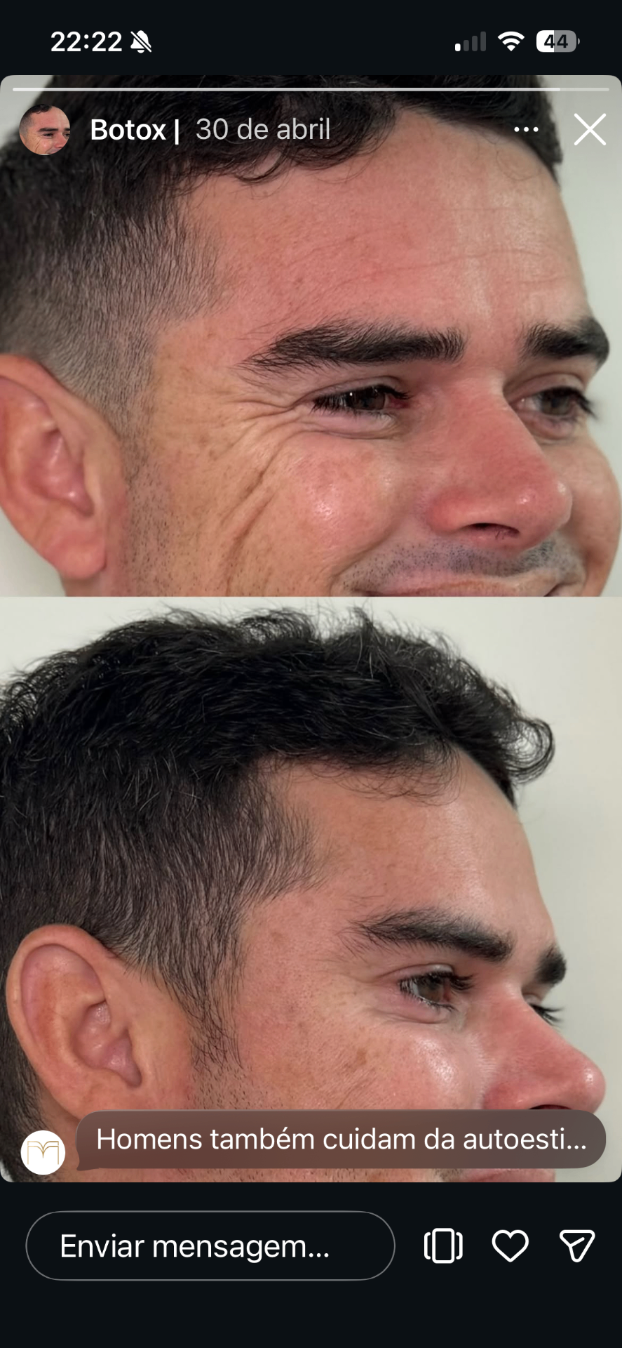 Botox — caso 7