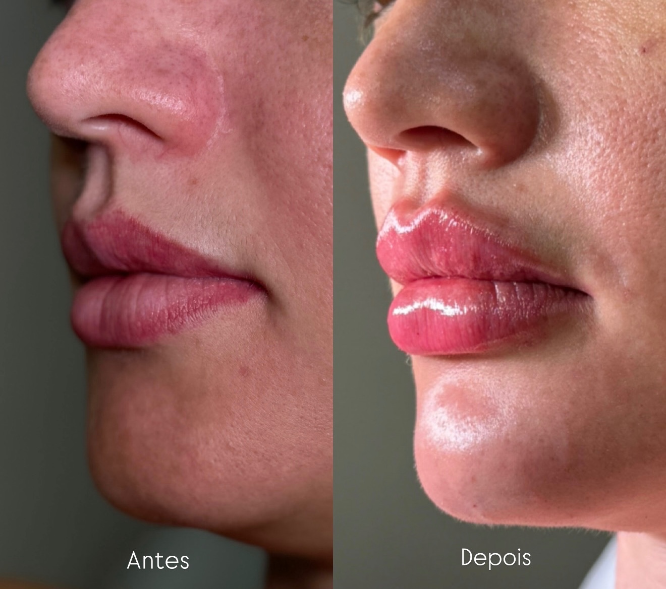 Preenchimento Labial — caso 11