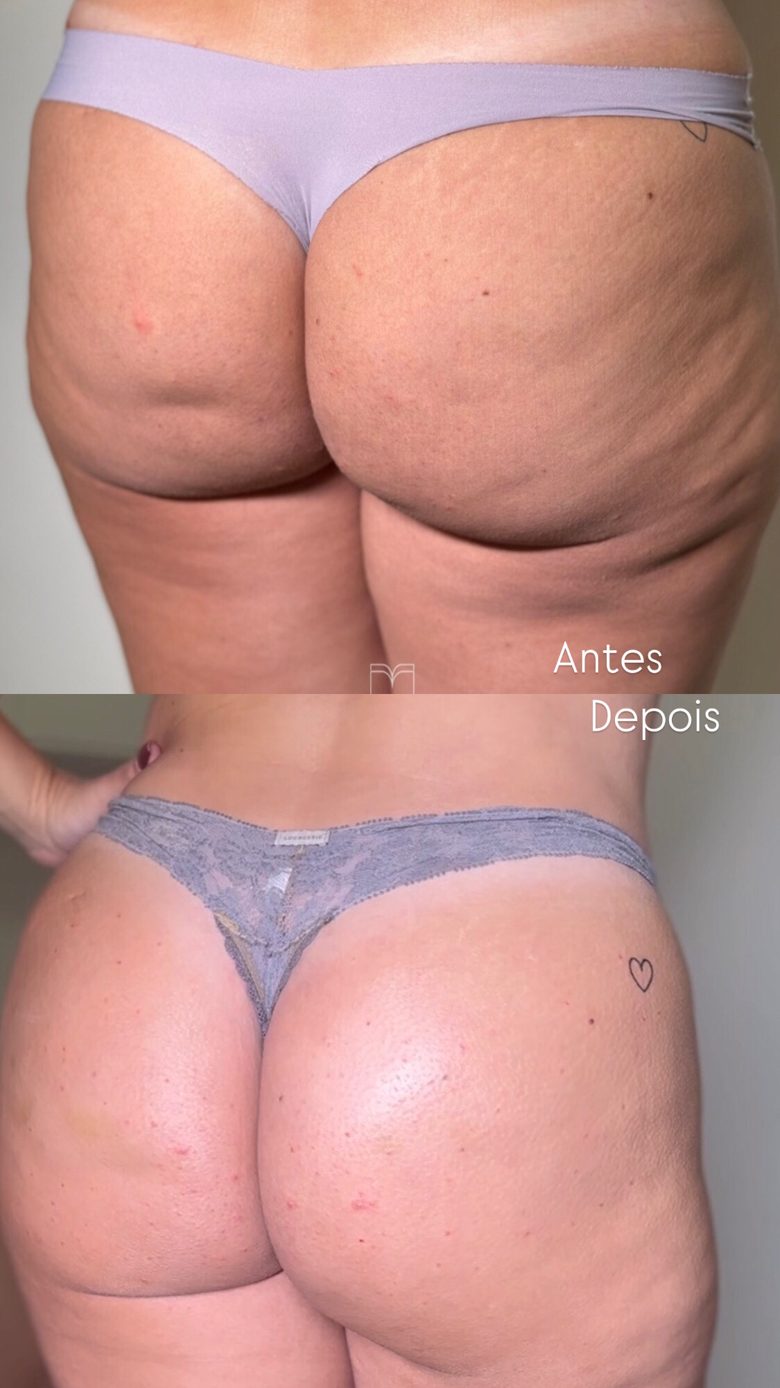 Bumbum Lift — caso 14