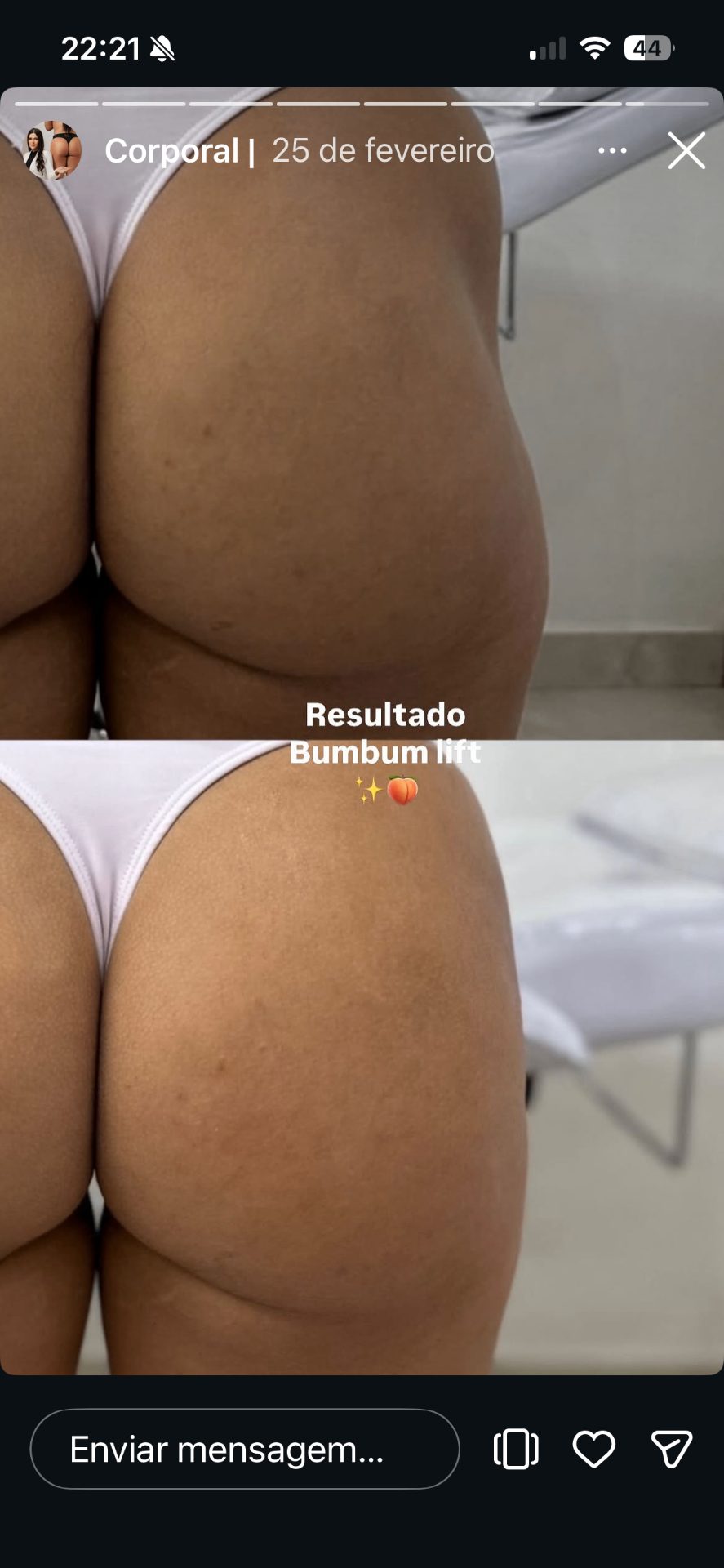 Bumbum Lift — caso 8