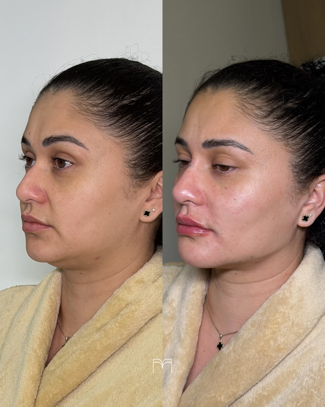 Harmonização Full Face — caso 1