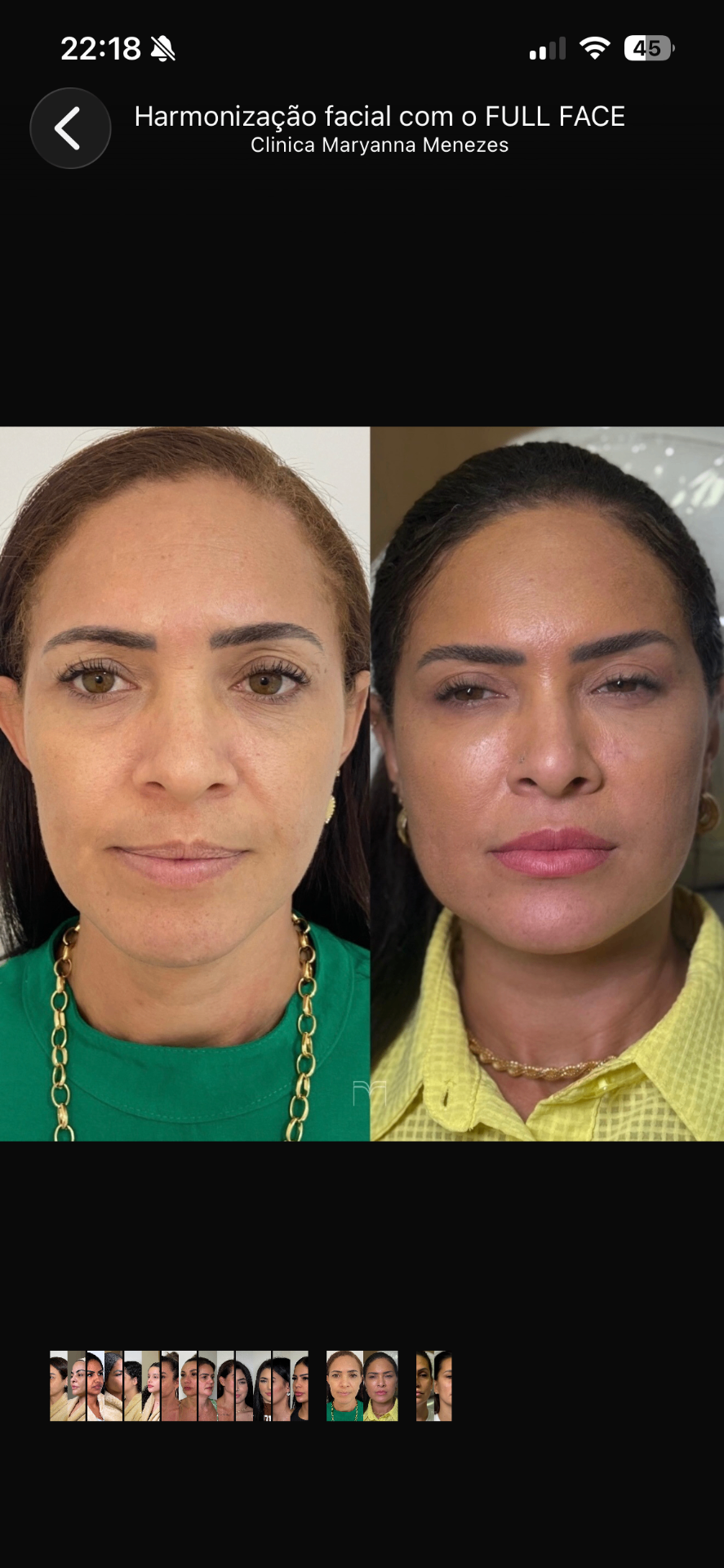 Full Face — caso 6