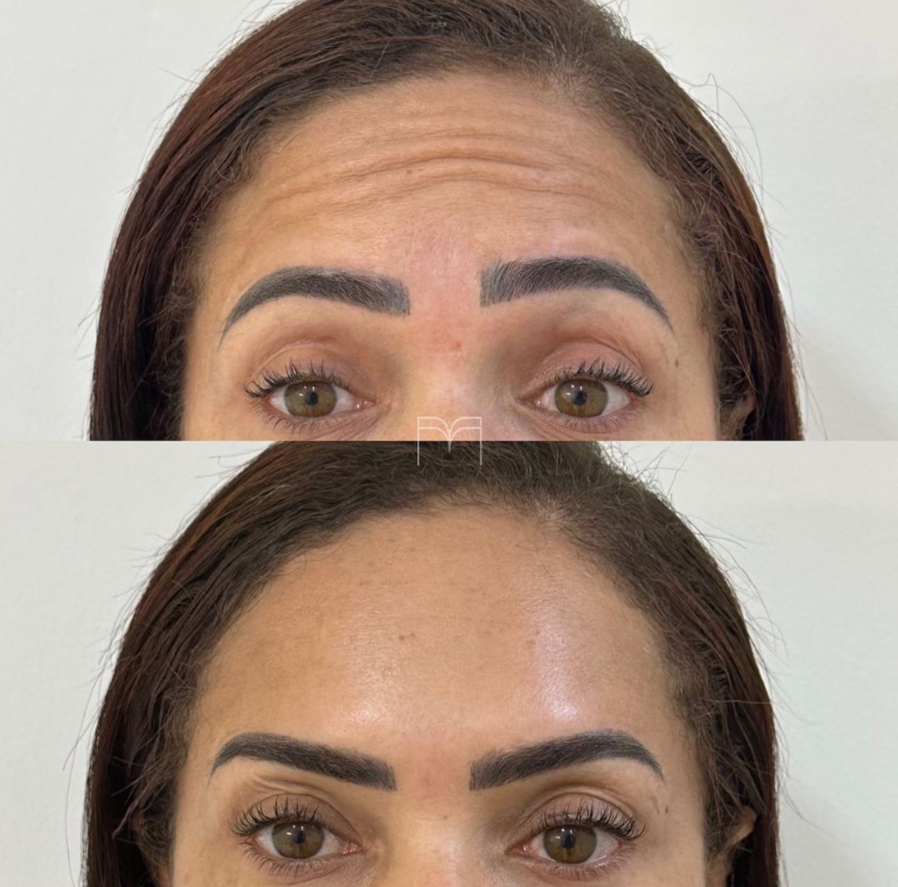 Resultado real 6 — Clínica Maryanna Menezes