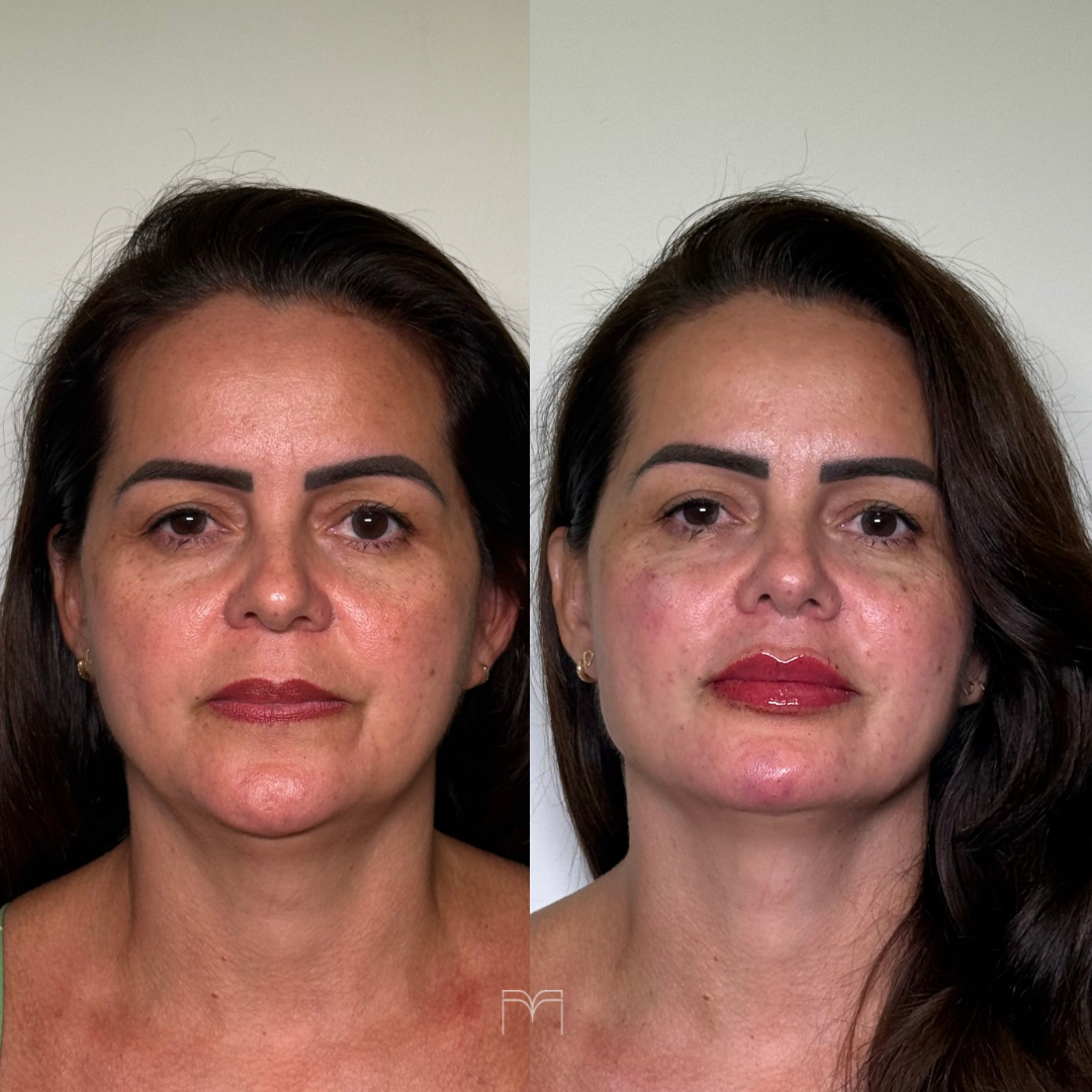 Harmonização Full Face — caso 4